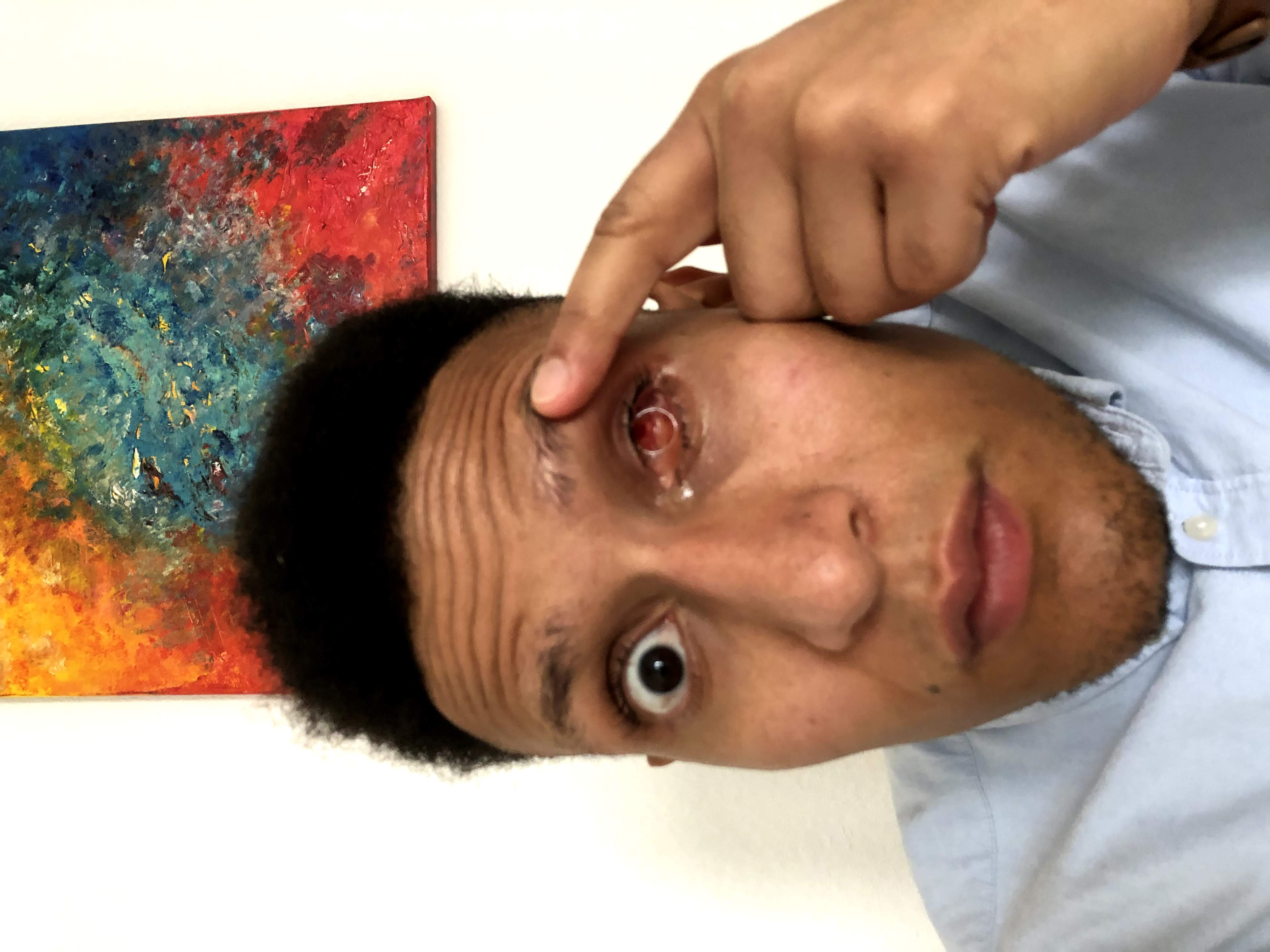 Nahaufnahme von Rickys Auge ohne Prothese